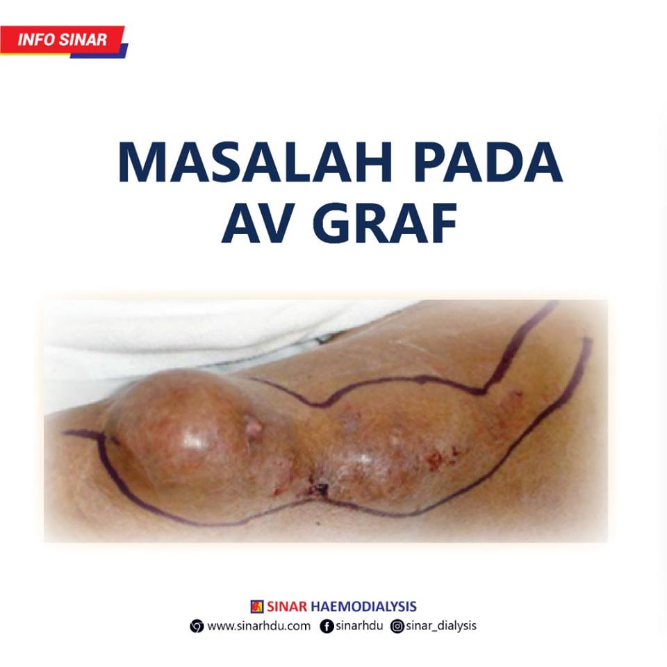 MASALAH PADA AV GRAF